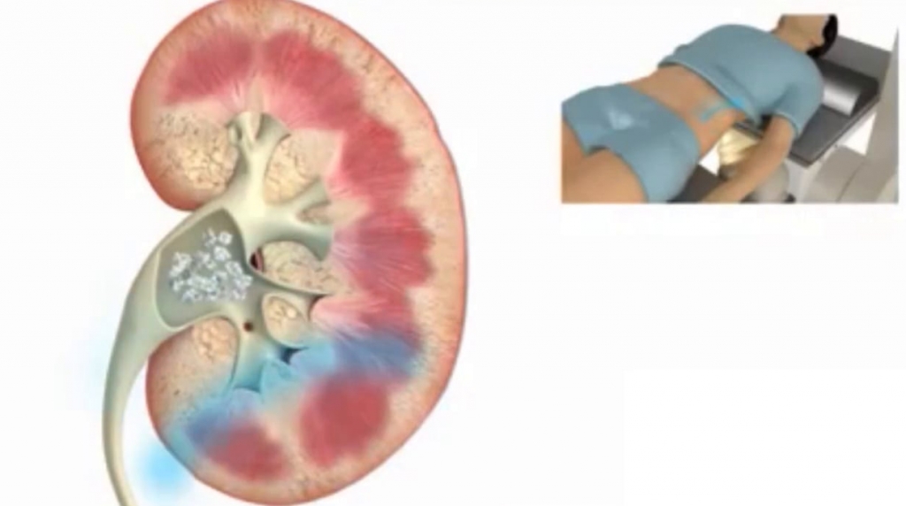 HOW TO DO A BLADDER FLUSH Wellness Evolutions